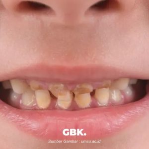 Penyebab Gigi Keropos pada Balita, Musuh Senyum Manis Si Kecil